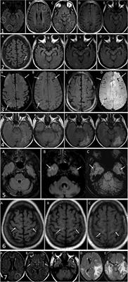 Imaging spectrum of amyloid-related imaging abnormalities associated with aducanumab immunotherapy